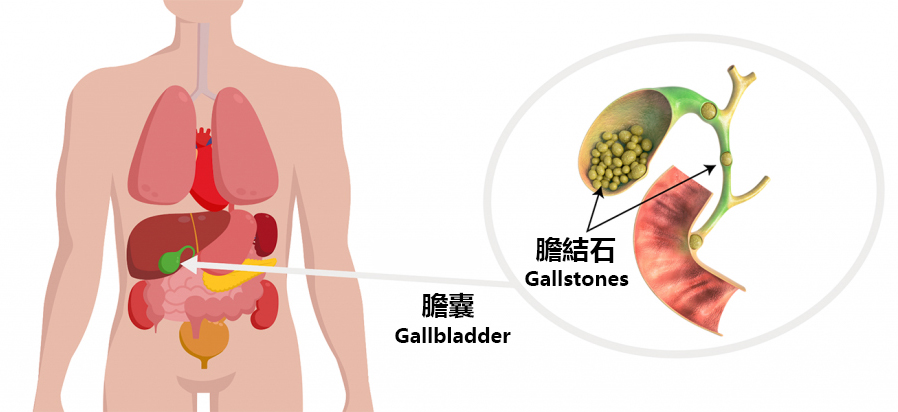 Gallstone