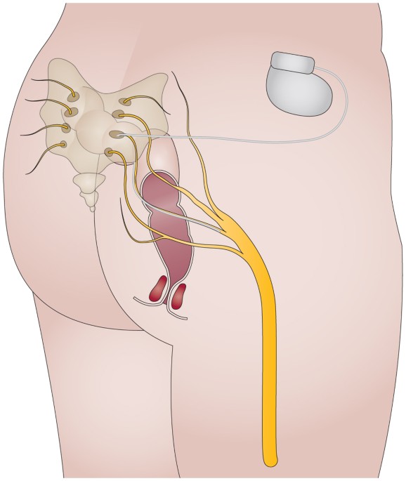 Sacral Nerve Stimulation (SNS)