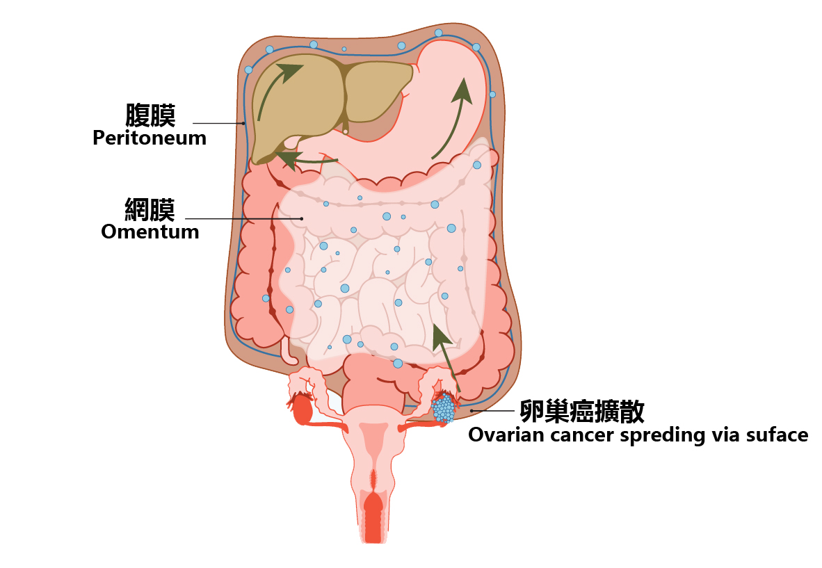 Peritoneal cancer